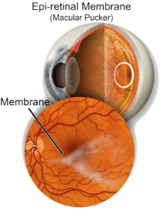 macular pucker