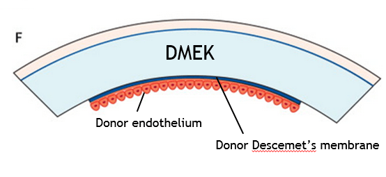 dmek corneal transplant surgery