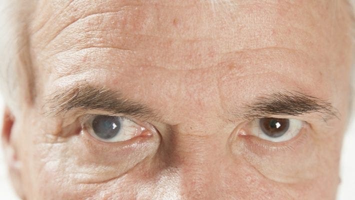 When to have cataract surgery