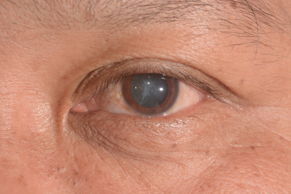 Cataracts in Eye