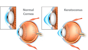 Illustration of eye with keratoconus