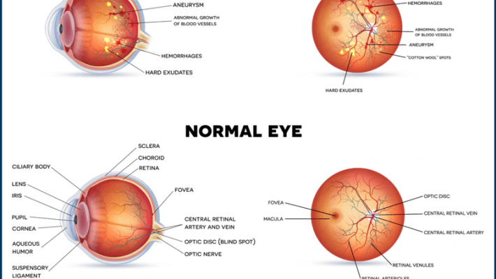 Diabetic Retinopathy