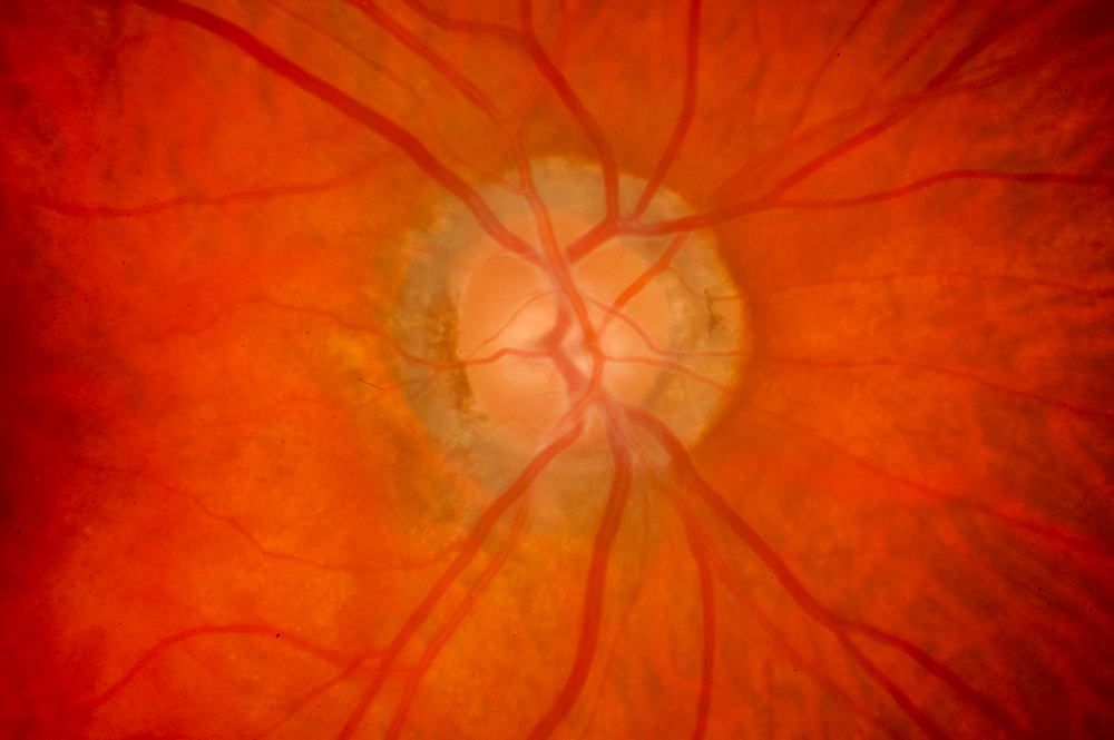 Vitreous Detachment Retina