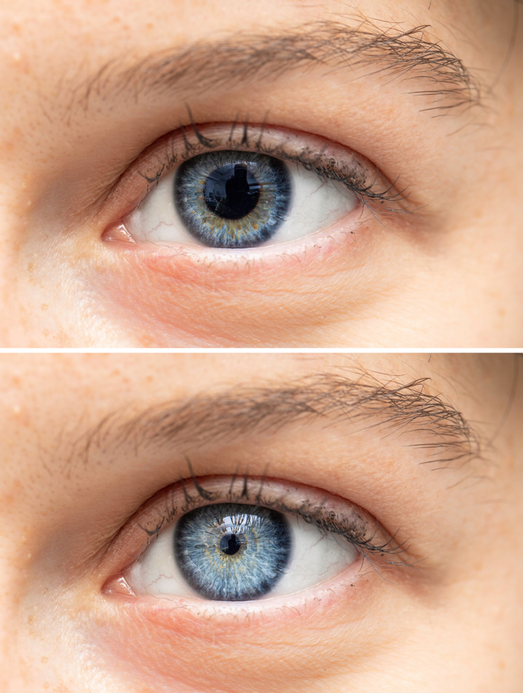 Comparison of blue eye with dilated pupils vs. constricted pupils.