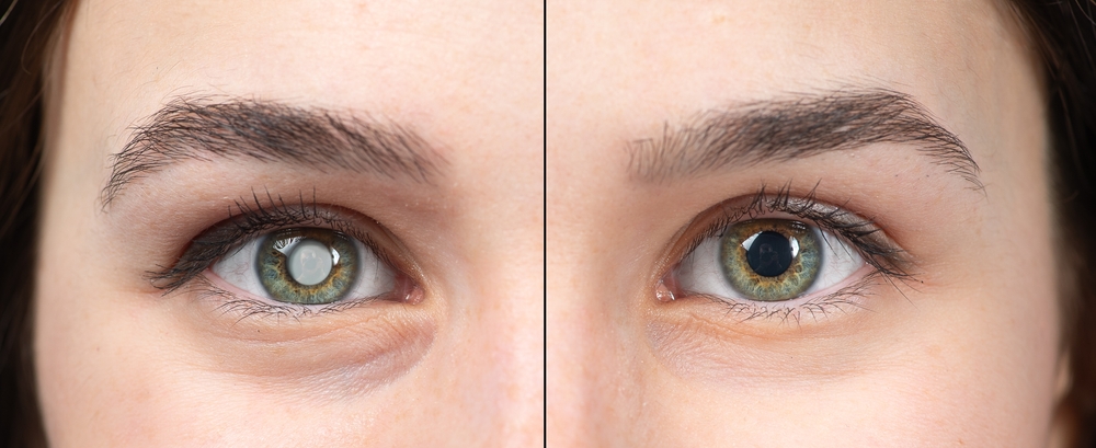 cataract surgery recovery