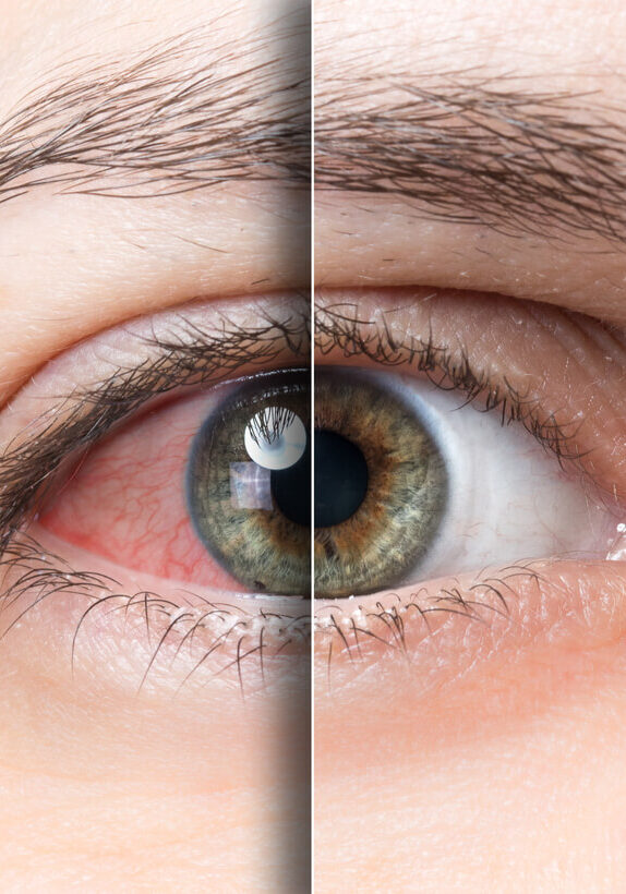 red-eye red-eye